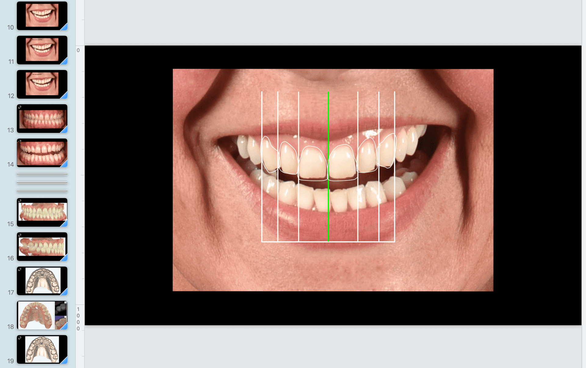 Close-up clinical photograph of a smile illustrating the Macro, Mid & Micro observation framework