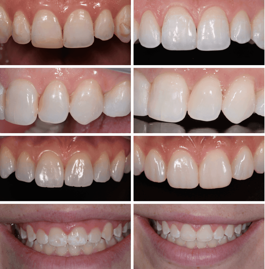 Before-and-after of a Class IV anterior composite restoration showing the fracture line erased after Island Layering.